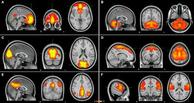 Resting-state functional MRI in treatment-resistant schizophrenia